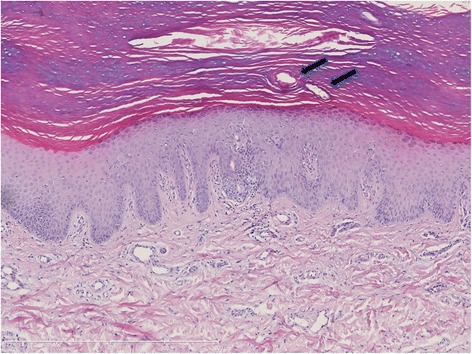 The first Danish family reported with an AQP5 mutation presenting diffuse non-epidermolytic palmoplantar keratoderma of Bothnian type, hyperhidrosis and frequent Corynebacterium infections: a case report.