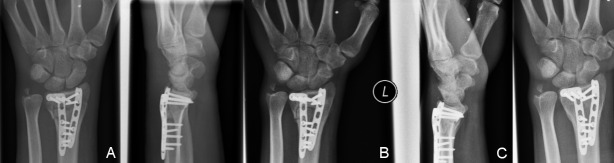 Fracture severity of distal radius fractures treated with locking plating correlates with limitations in ulnar abduction and inferior health-related quality of life.