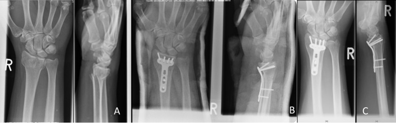 Fracture severity of distal radius fractures treated with locking plating correlates with limitations in ulnar abduction and inferior health-related quality of life.