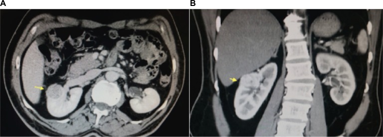 Renal artery pseudoaneurysm after robotic-assisted partial nephrectomy: case report.