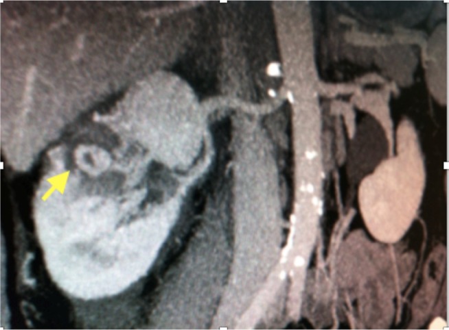 Renal artery pseudoaneurysm after robotic-assisted partial nephrectomy: case report.
