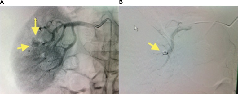 Renal artery pseudoaneurysm after robotic-assisted partial nephrectomy: case report.