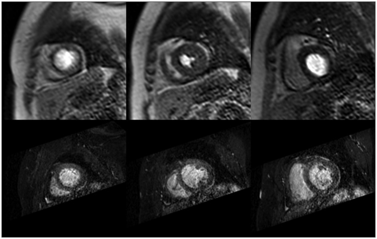 Patient-specific coronary blood supply territories for quantitative perfusion analysis.