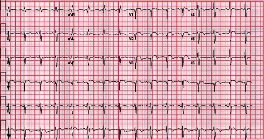 Clostridium Difficile Infection and Takotsubo Cardiomyopathy: Is There a Relation?