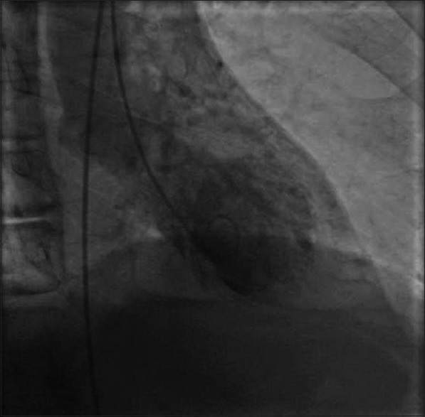 Clostridium Difficile Infection and Takotsubo Cardiomyopathy: Is There a Relation?