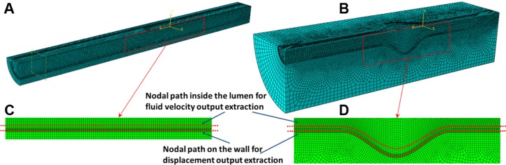 FSI Simulations of Pulse Wave Propagation in Human Abdominal Aortic Aneurysm: The Effects of Sac Geometry and Stiffness.