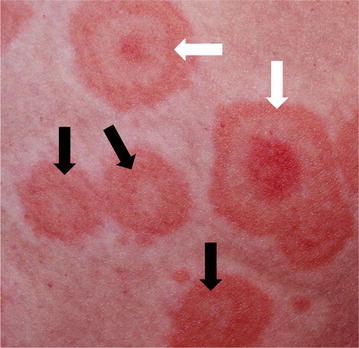 Drug induced exfoliative dermatitis: state of the art.