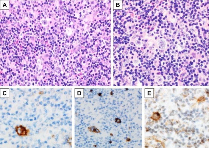 Concomitant Classic Hodgkin Lymphoma of Lymph Node and cMYC-Positive Burkitt Leukemia/Lymphoma of the Bone Marrow Presented Concurrently at the Time of Presentation: A Rare Combination of Discordant Lymphomas.