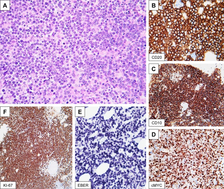 Concomitant Classic Hodgkin Lymphoma of Lymph Node and cMYC-Positive Burkitt Leukemia/Lymphoma of the Bone Marrow Presented Concurrently at the Time of Presentation: A Rare Combination of Discordant Lymphomas.