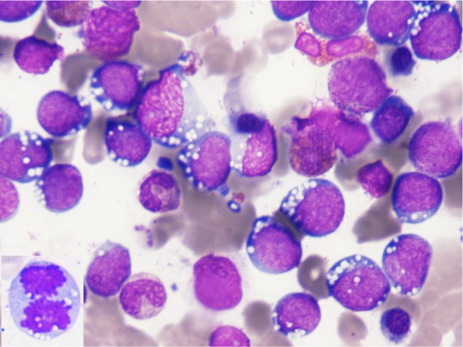 Concomitant Classic Hodgkin Lymphoma of Lymph Node and cMYC-Positive Burkitt Leukemia/Lymphoma of the Bone Marrow Presented Concurrently at the Time of Presentation: A Rare Combination of Discordant Lymphomas.