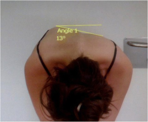 Trunk appearance perception scale for physicians (TAPS-Phy) - a valid and reliable tool to rate trunk deformity in idiopathic scoliosis.