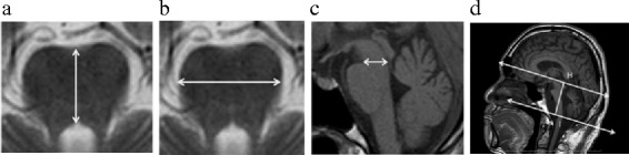 MRI-based cerebellar volume measurements correlate with the International Cooperative Ataxia Rating Scale score in patients with spinocerebellar degeneration or multiple system atrophy.