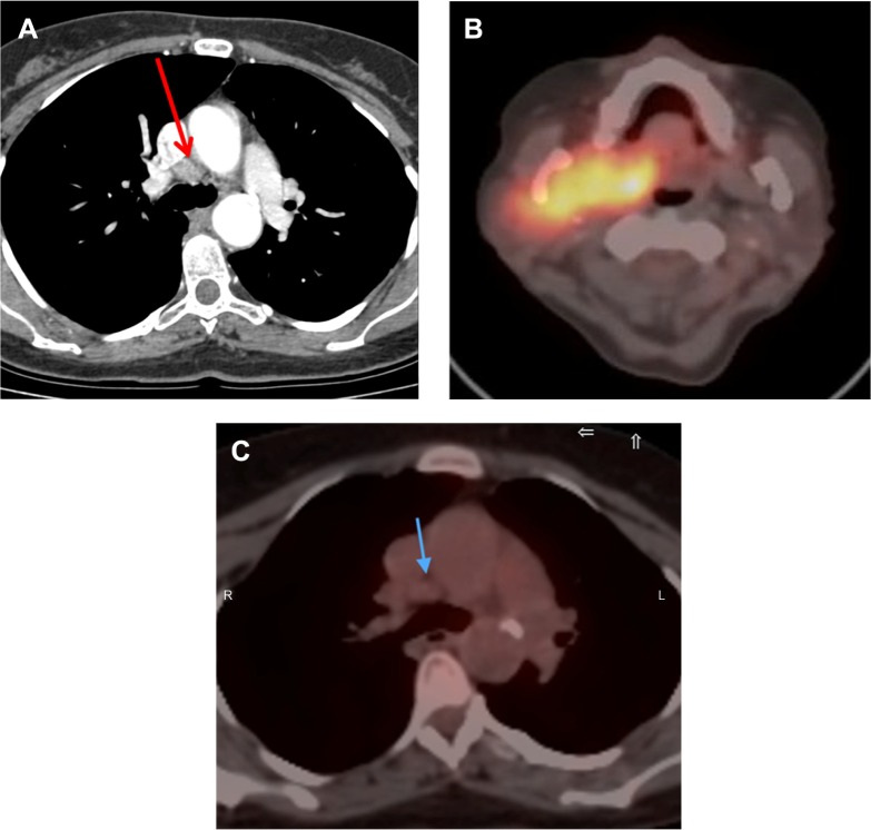 Low-Dose PET/CT and Full-Dose Contrast-Enhanced CT at the Initial Staging of Localized Diffuse Large B-Cell Lymphomas.