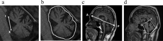 MRI-based cerebellar volume measurements correlate with the International Cooperative Ataxia Rating Scale score in patients with spinocerebellar degeneration or multiple system atrophy.