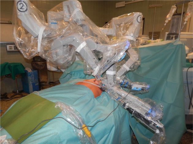 Robotic-assisted thymectomy: current perspectives.