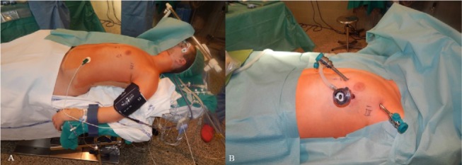 Robotic-assisted thymectomy: current perspectives.