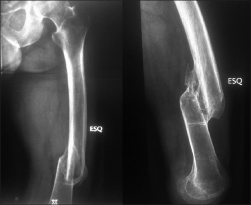 Subtrochanteric and Distal Femur Fractures in a Patient with Femoral Shaft Fracture Malunion and Knee Disarticulation: A Rare and Challenging Case Report.