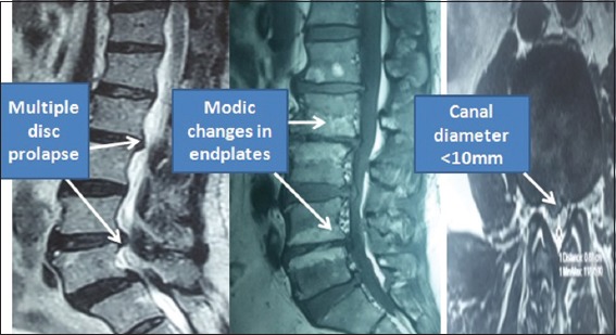 Wasting of Extensor Digitorum Brevis as a Decisive Preoperative Clinical Indicator of Lumbar Canal Stenosis: A Single-center Prospective Cohort Study.