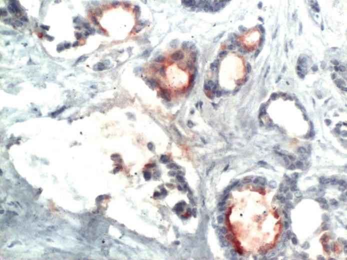 Association of ICAM-1, VCAM-1, CYCLIN D1 and Cathepsin D with Clinicopathological Parameters in Breast Carcinoma; an Immunohistochemical Study.