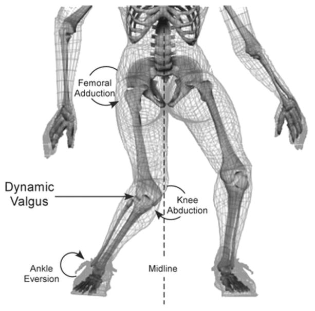 How Anterior Cruciate Ligament Injury was averted during Knee Collapse in a NBA Point Guard.