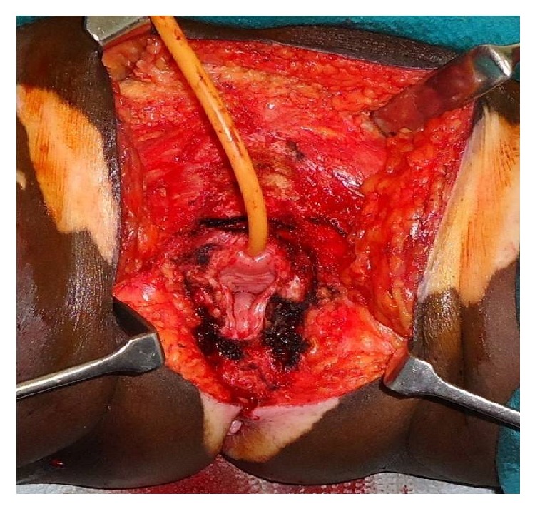 Treatment Outcome of Carcinoma Vulva Ten-Year Experience from a Tertiary Cancer Centre in South India.