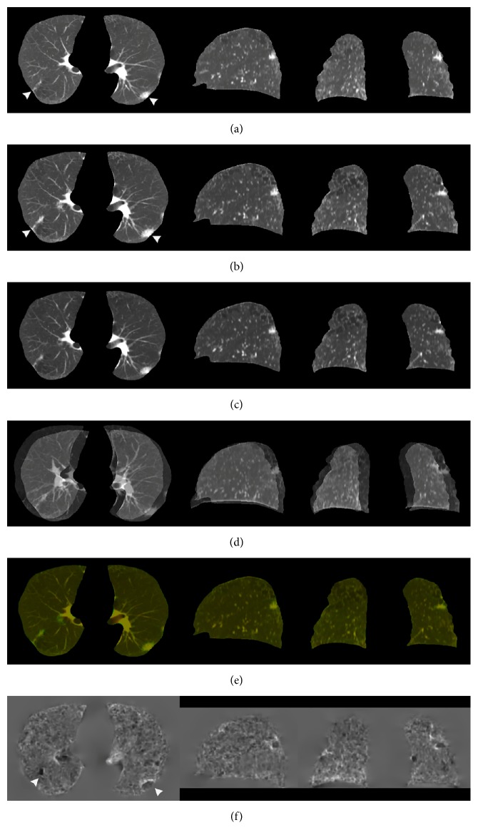 Evaluation of Deformable Image Registration for Three-Dimensional Temporal Subtraction of Chest Computed Tomography Images.