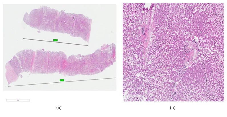 Comparison of the Diagnostic Yield of EUS Needles for Liver Biopsy: Ex Vivo Study.