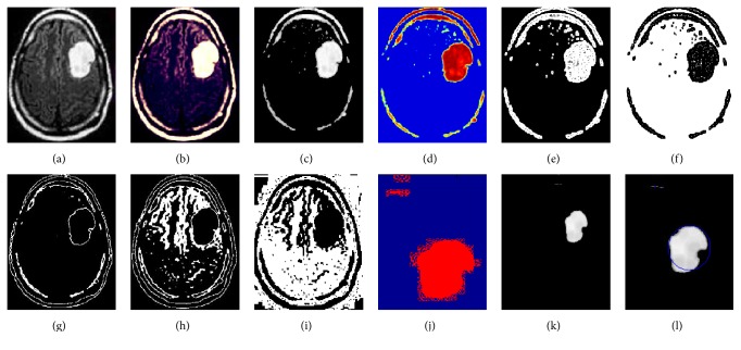 Image Analysis for MRI Based Brain Tumor Detection and Feature Extraction Using Biologically Inspired BWT and SVM.