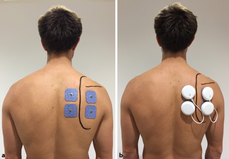 Use of shoulder pacemaker for treatment of functional shoulder instability: Proof of concept.