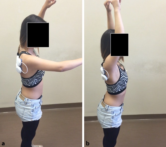 Use of shoulder pacemaker for treatment of functional shoulder instability: Proof of concept.