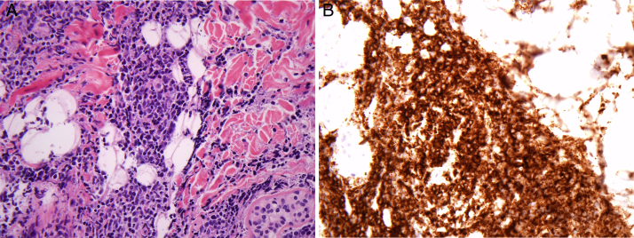 Isolated skin relapse of Philadelphia chromosome-positive acute lymphoblastic leukemia after allogeneic stem cell transplant