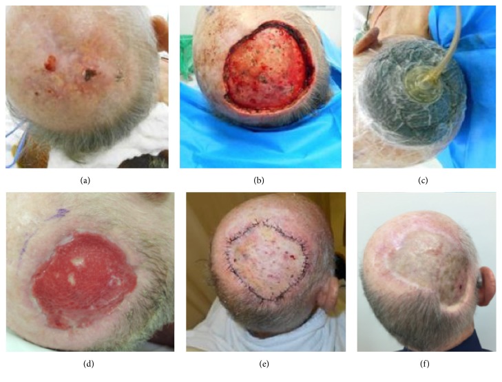 Dermal Substitutes Use in Reconstructive Surgery for Skin Tumors: A Single-Center Experience.