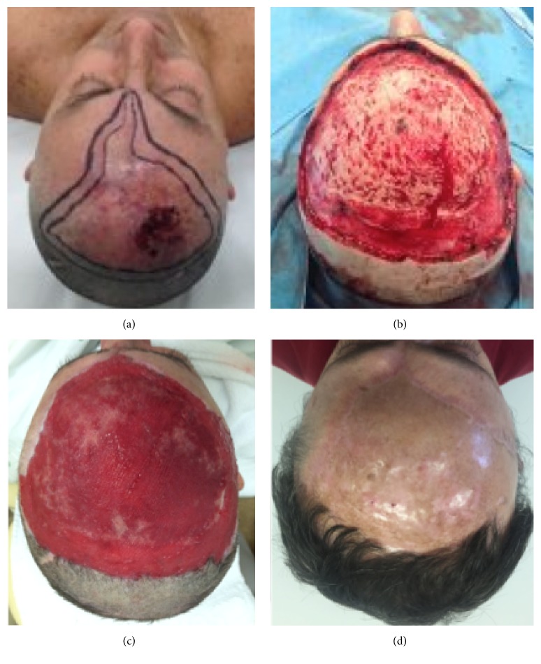 Dermal Substitutes Use in Reconstructive Surgery for Skin Tumors: A Single-Center Experience.