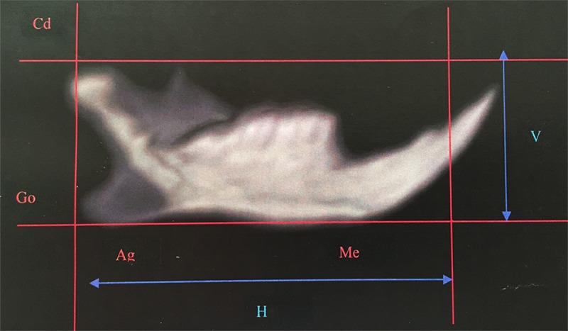 Effects of pamidronate administration on tooth eruption and mandibular growth in new born rats.