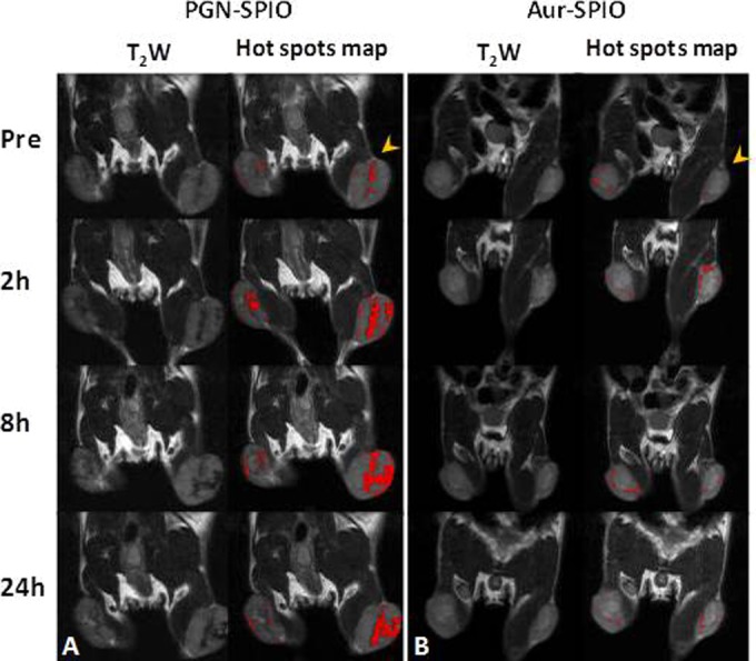 Phosphatidylserine-Targeted Nanotheranostics for Brain Tumor Imaging and Therapeutic Potential.