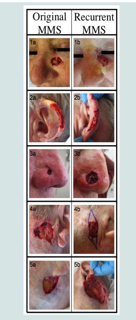 Clinical Characteristics of Non-Melanoma Skin Cancers Recurring within 5 years after Mohs Micrographic Surgery: Single Institution Retrospective Chart Review.