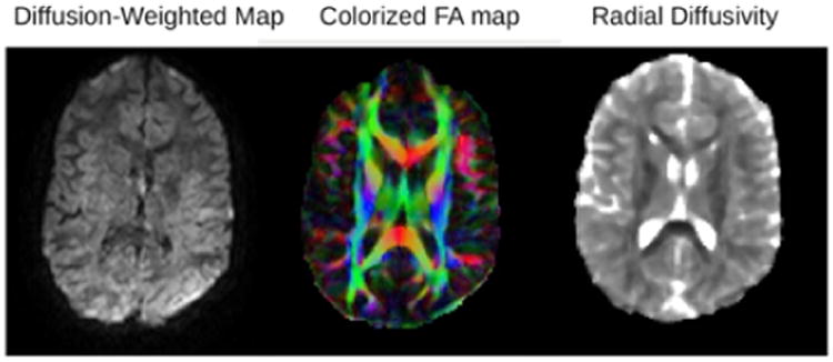 Relationships between Eye Movements during Sentence Reading Comprehension, Word Spelling and Reading, and DTI and fmri Connectivity In Students with and without Dysgraphia or Dyslexia.