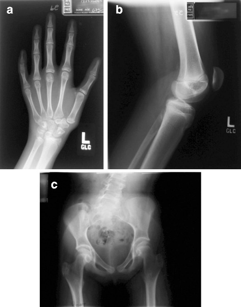 A patient with van Maldergem syndrome with endocrine abnormalities, hypogonadotropic hypogonadism, and breast aplasia/hypoplasia.