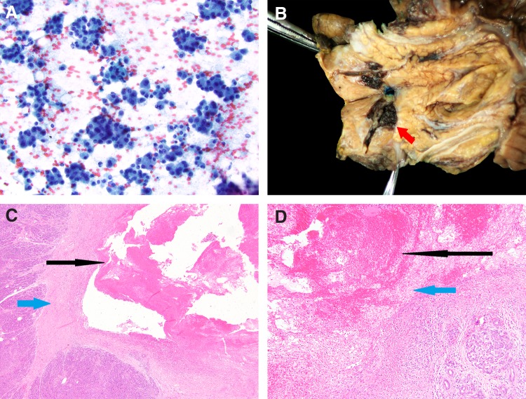 An Unexpected Etiology of Pancreatic Panniculitis: A Case Report.