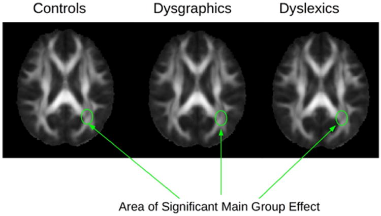 Relationships between Eye Movements during Sentence Reading Comprehension, Word Spelling and Reading, and DTI and fmri Connectivity In Students with and without Dysgraphia or Dyslexia.