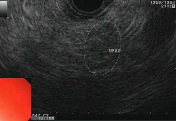 An Unexpected Etiology of Pancreatic Panniculitis: A Case Report.