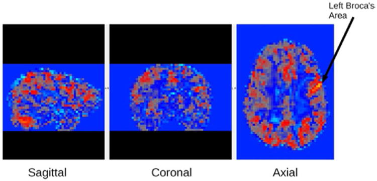 Relationships between Eye Movements during Sentence Reading Comprehension, Word Spelling and Reading, and DTI and fmri Connectivity In Students with and without Dysgraphia or Dyslexia.