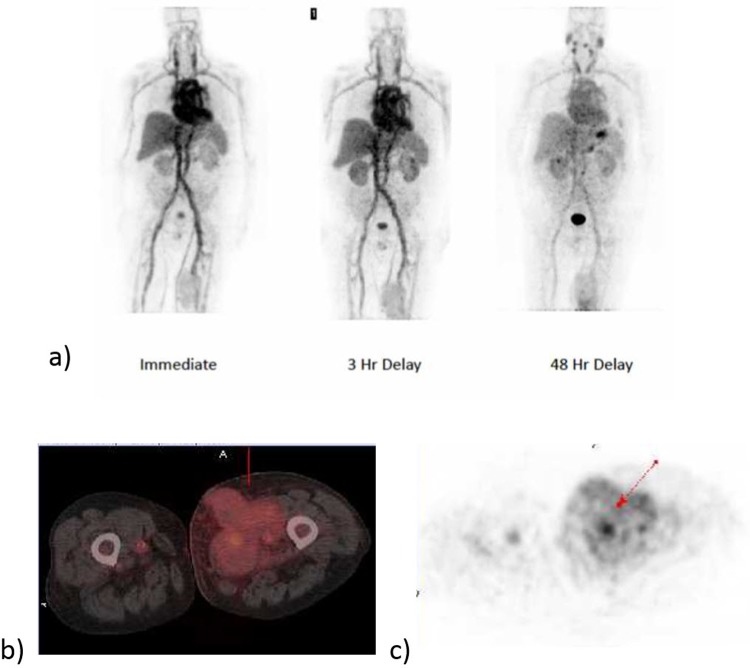 First-in-Man Evaluation of <sup>124</sup>I-PGN650: A PET Tracer for Detecting Phosphatidylserine as a Biomarker of the Solid Tumor Microenvironment.