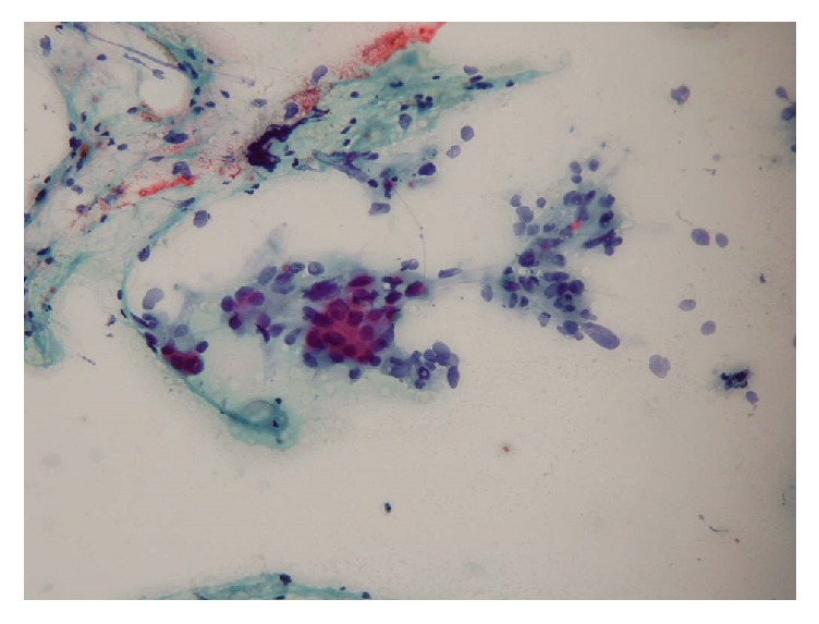 Hypermetabolic Thyroid Incidentaloma on Positron Emission Tomography: Review of Laboratory, Radiologic, and Pathologic Characteristics.