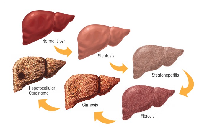 Alcoholic Liver Disease: Pathogenesis and Current Management.