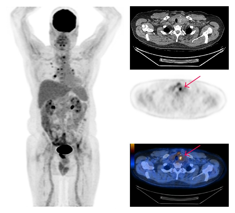 Hypermetabolic Thyroid Incidentaloma on Positron Emission Tomography: Review of Laboratory, Radiologic, and Pathologic Characteristics.