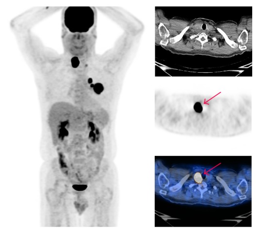 Hypermetabolic Thyroid Incidentaloma on Positron Emission Tomography: Review of Laboratory, Radiologic, and Pathologic Characteristics.