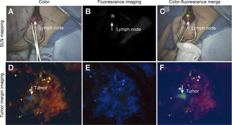 Combination of Fluorescence-Guided Surgery With Photodynamic Therapy for the Treatment of Cancer.