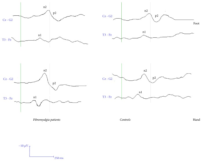 Pain Processing and Vegetative Dysfunction in Fibromyalgia: A Study by Sympathetic Skin Response and Laser Evoked Potentials.