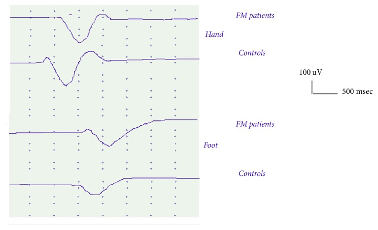 Pain Processing and Vegetative Dysfunction in Fibromyalgia: A Study by Sympathetic Skin Response and Laser Evoked Potentials.